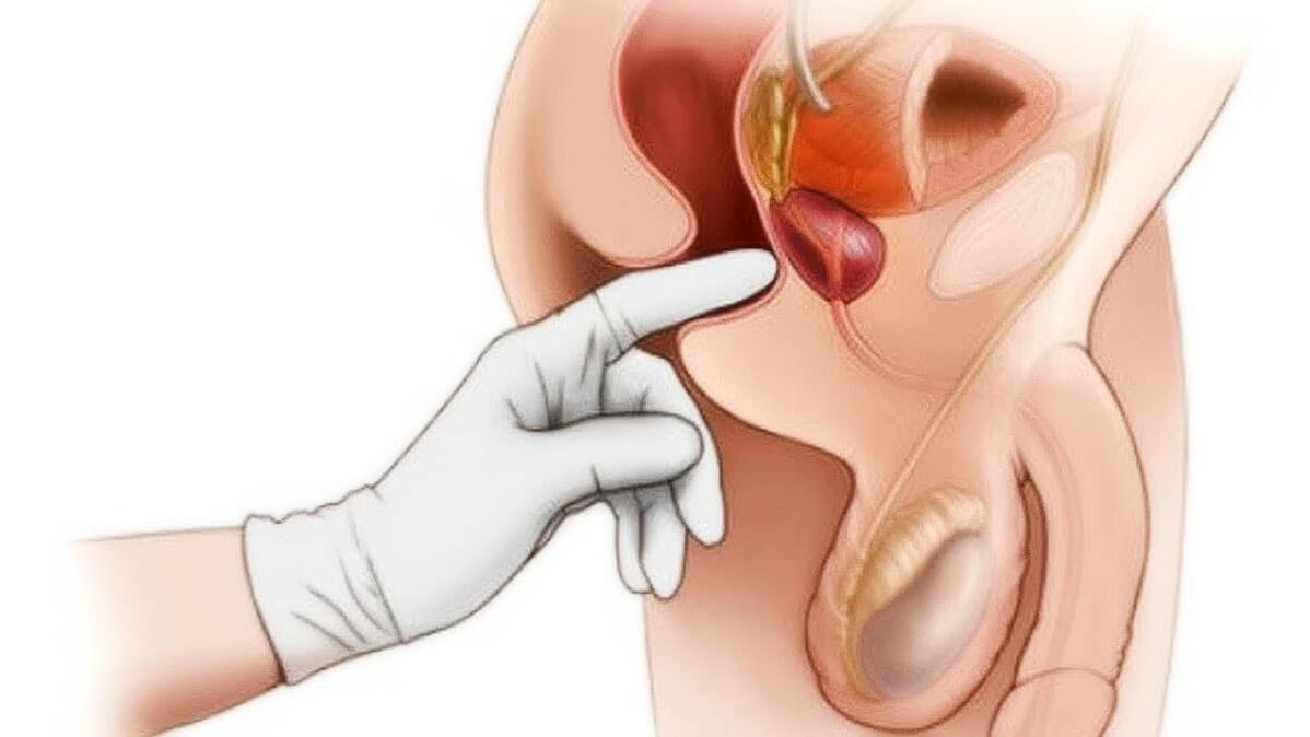 diagnóstico de prostatite e seu tratamento com o dispositivo