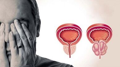 As razões para o desenvolvimento da prostatite em homens