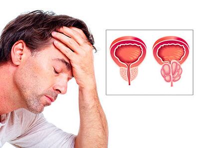 Os sintomas da prostatite preocupam um homem