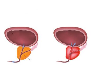 Próstata normal e inflamada